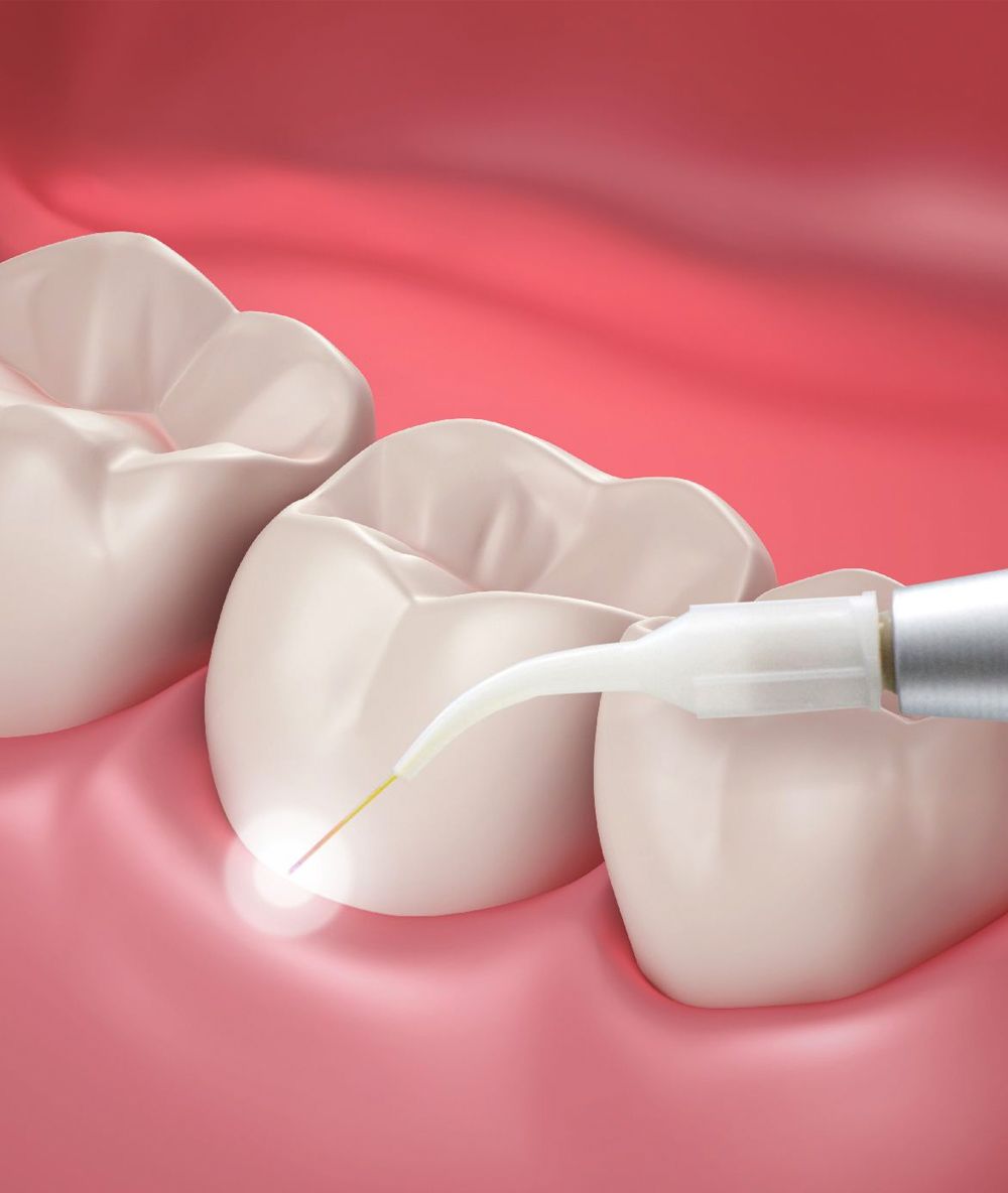 лазерная стоматология, которая полагается на безопасные и мощные лазеры для решения стоматологических проблем